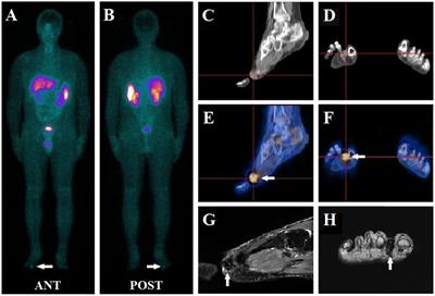 Diagnostic accuracy of 99mTc-HYNIC-TOC SPECT/CT for detecting osteomalacia-associated tumors